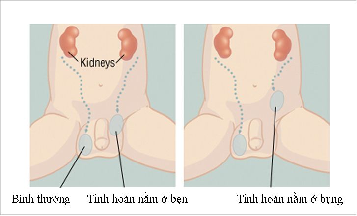 Tất tần tật thông tin về ẩn tinh hoàn - Những điều cần biết