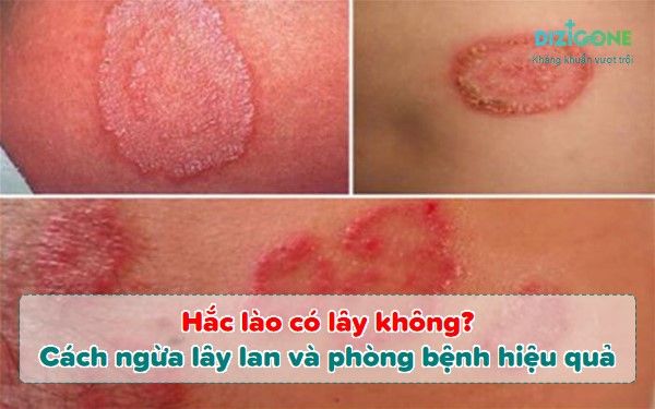 Bệnh hắc lào có lây không? Tìm hiểu chi tiết về bệnh lý này