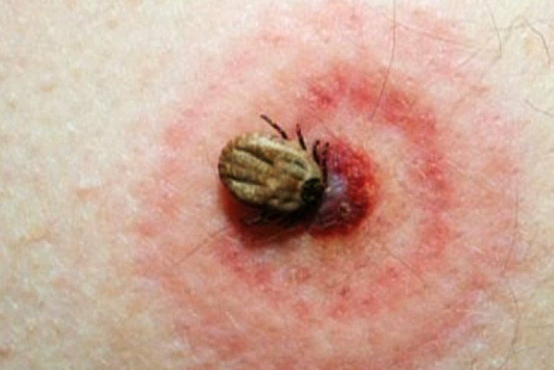 Bệnh Lyme là gì? Tìm hiểu nguyên nhân, triệu chứng và phòng tránh