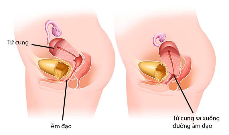 Tất tần tật thông tin về bệnh sa tử cung - Nguyên nhân, triệu chứng và phương pháp điều trị