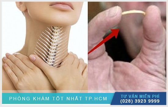 Bị hóc xương cá nhỏ - Nguyên nhân, triệu chứng và cách xử lý