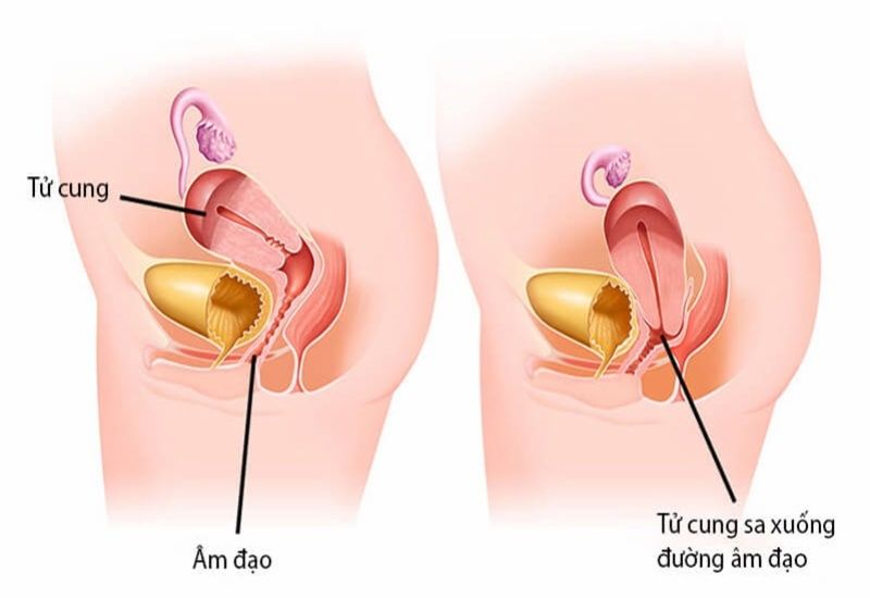 Bí quyết giúp giảm thiểu tình trạng bị lồi cục thịt ở cửa mình sau sinh