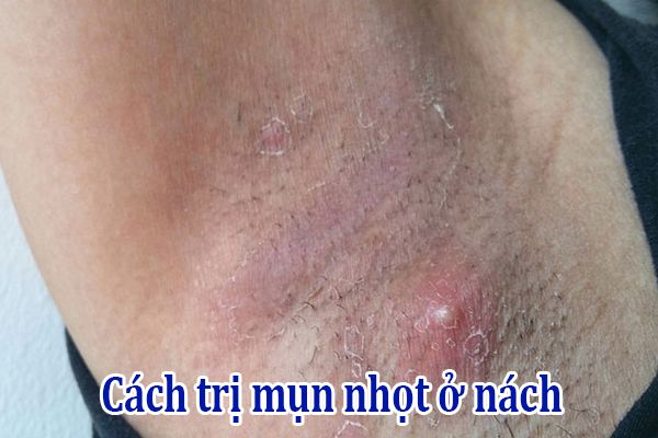 Cách chăm sóc và trị mụt nhọt ở nách hiệu quả