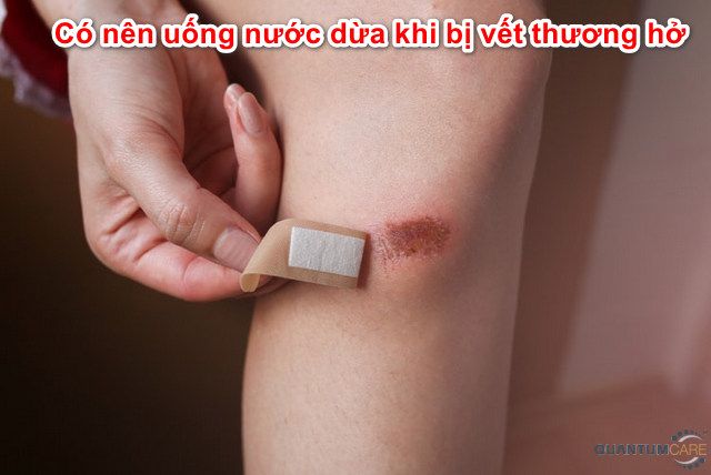 Bị vết thương hở có uống nước dừa được không? Tìm hiểu sự thật và lợi ích của việc sử dụng nước dừa cho vết thương hở