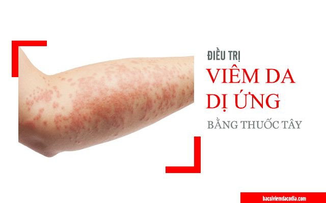 Tổng quan về bị viêm da dị ứng: Nguyên nhân, triệu chứng và cách điều trị