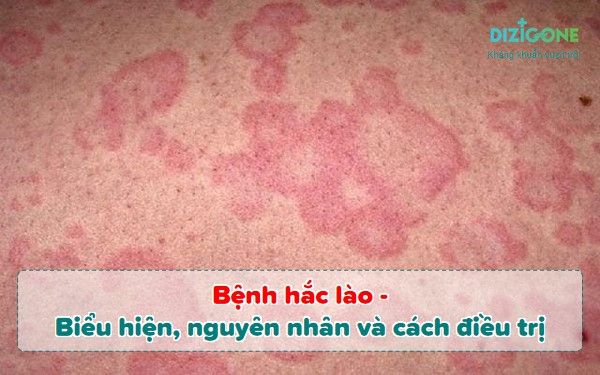 Biểu hiện hắc lào - Tất cả những gì bạn cần biết