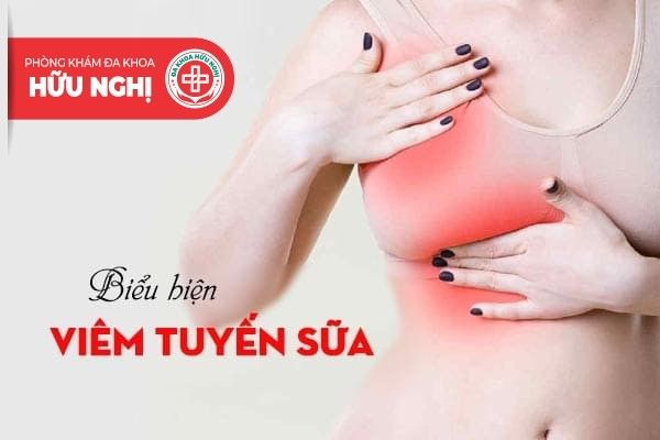 Biểu hiện viêm tuyến sữa - Những dấu hiệu cần chú ý và cách điều trị hiệu quả