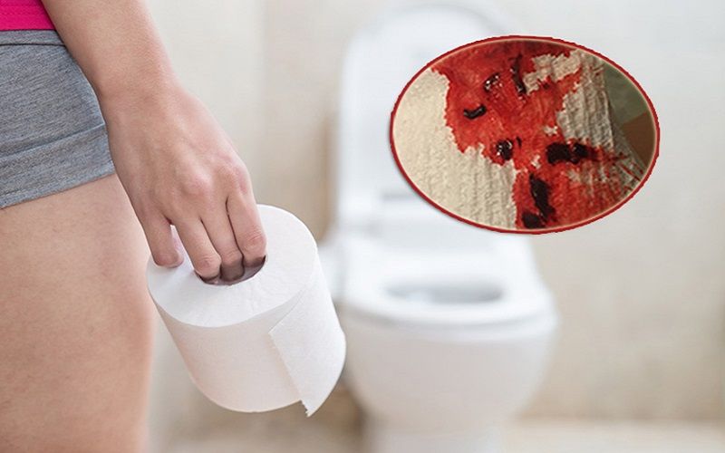 Cách chữa bệnh trĩ đi ngoài ra máu - Những phương pháp hiệu quả và an toàn