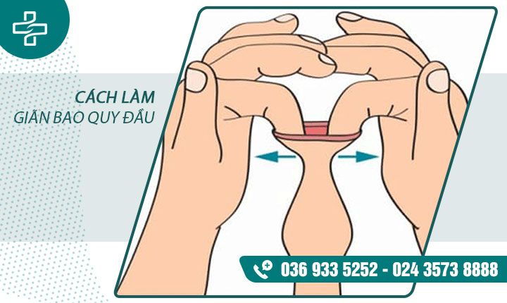 Cách làm cho bao quy đầu rộng ra - Các phương pháp hiệu quả và an toàn