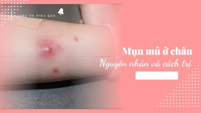 Cách trị mủ ở chân hiệu quả và nhanh chóng trong 7 ngày