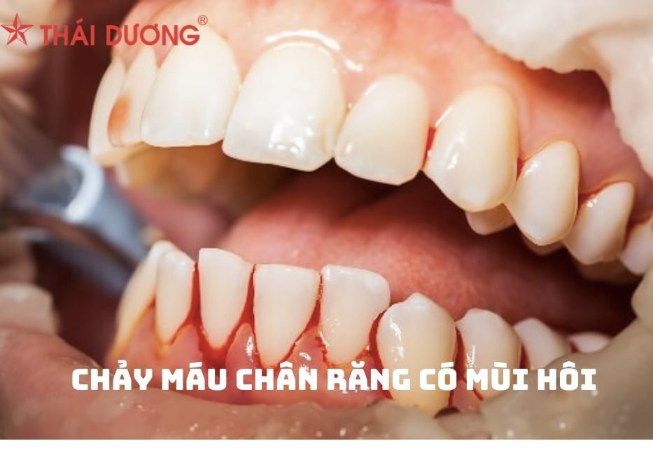 6 Nguyên nhân chân răng bị hôi và cách khắc phục hiệu quả