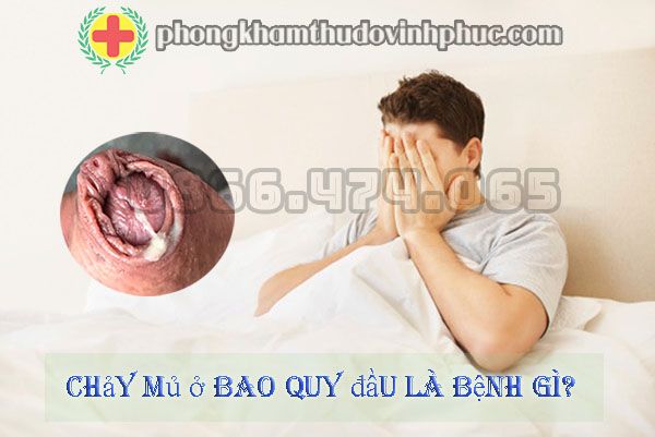 Tất tần tật thông tin về chảy mủ ở bao quy đầu