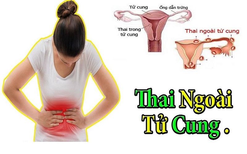 Chửa ngoài dạ con có hiện tượng gì? Tìm hiểu ngay để biết thêm chi tiết!