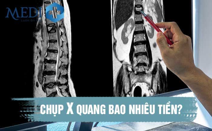 Chụp X quang phổi giá bao nhiêu? Bảng giá chụp X quang phổi hiện nay