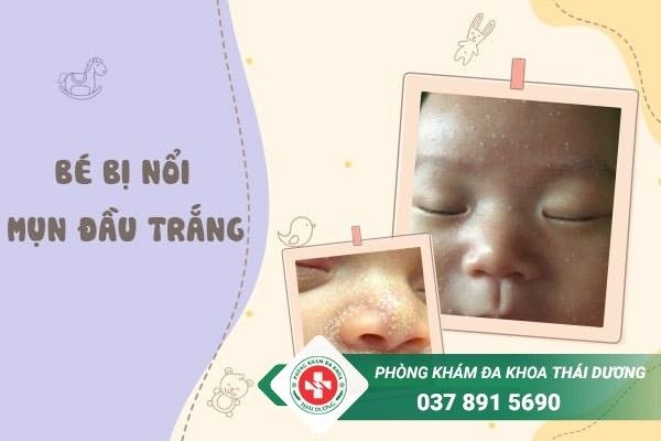 Da bị nổi mụn trắng: Nguyên nhân và cách trị hiệu quả