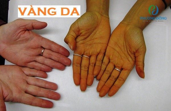 Tìm hiểu đặc điểm của vàng da trước gan