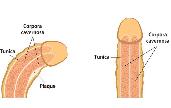 Tìm hiểu nguyên nhân và cách điều trị đau dương vật