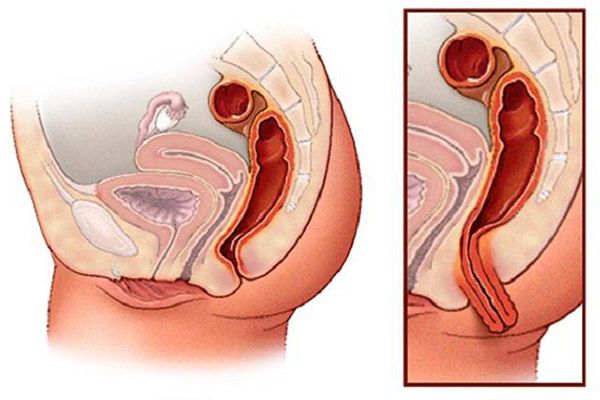 Dấu hiệu bị sa tử cung - Những tín hiệu bạn cần biết