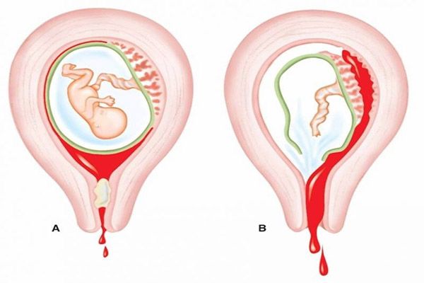 Dấu hiệu sót thai - Nhận biết sớm để phòng tránh