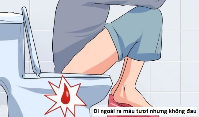 Đi cầu ra máu không đau rát: Nguyên nhân và cách điều trị hiệu quả