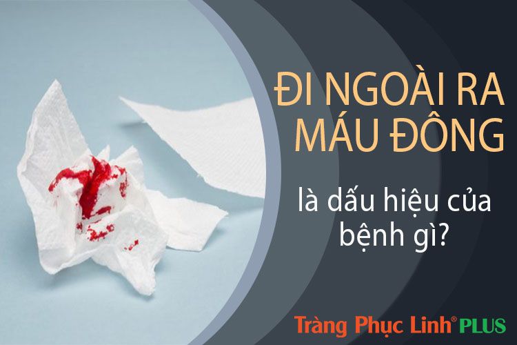 Tất tần tật thông tin về Đi ngoài ra máu đông - Nguyên nhân, triệu chứng và điều trị