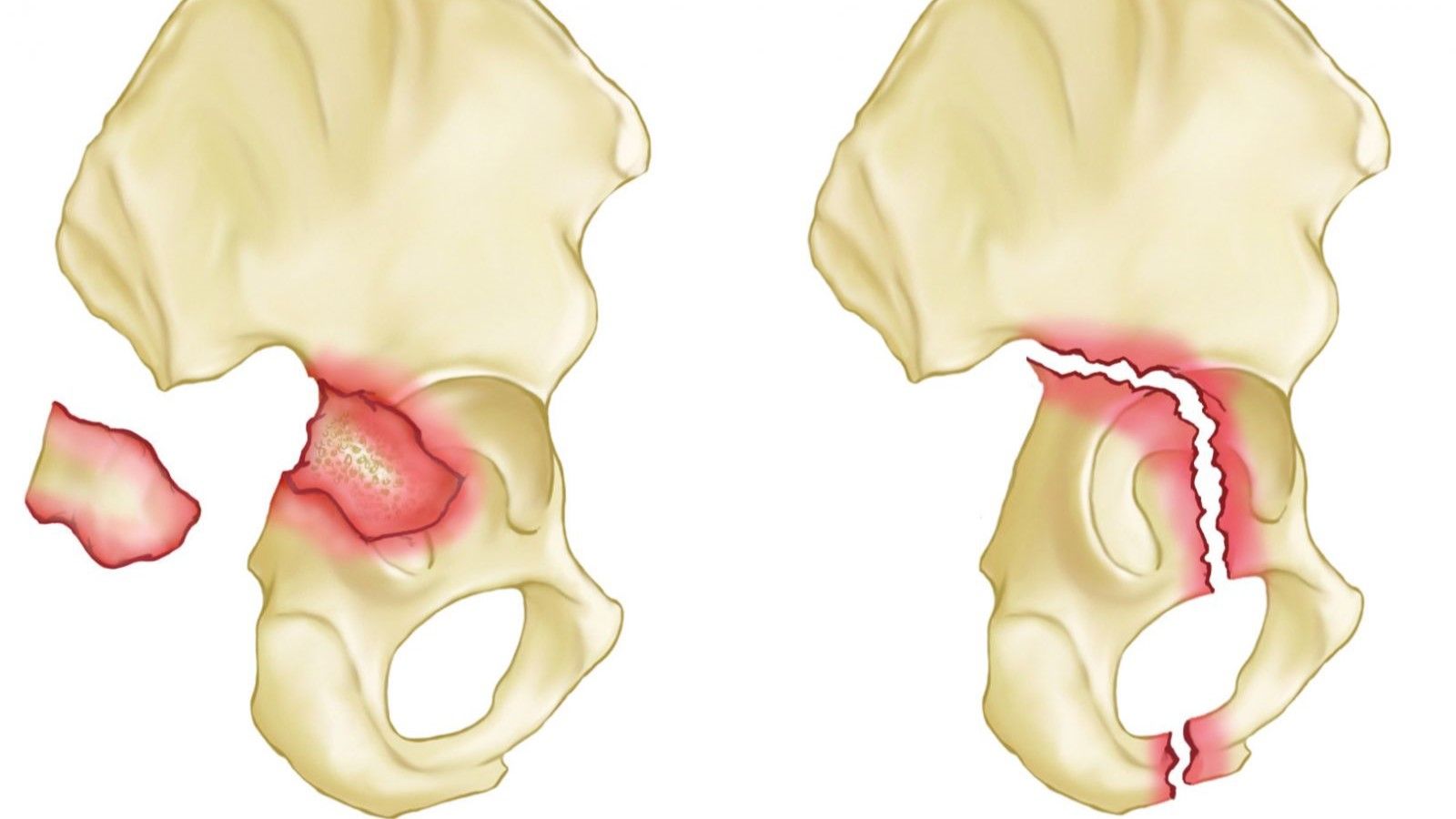 Tất tần tật về gãy xương chậu - Thời gian lành và cách phục hồi hiệu quả