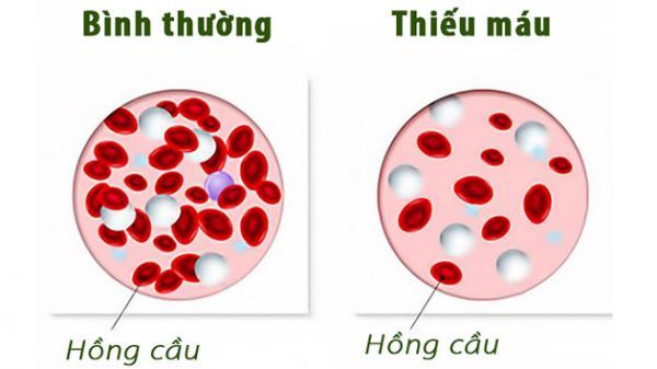 Giảm hồng cầu có nguy hiểm không? Tìm hiểu sự thật về tình trạng giảm hồng cầu