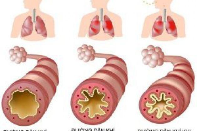 Hen Suyễn Có Di Truyền Không - Bạn Nên Biết Gì Về Yếu Tố Di Truyền