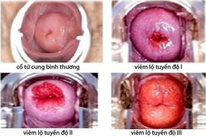 Tìm hiểu về hình ảnh viêm cổ tử cung và cách phòng ngừa