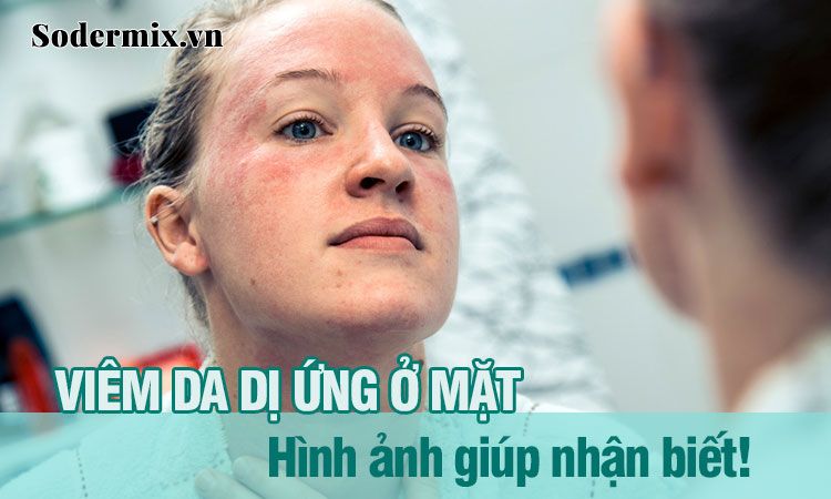 Hình ảnh viêm da dị ứng: Nhận biết và cách điều trị