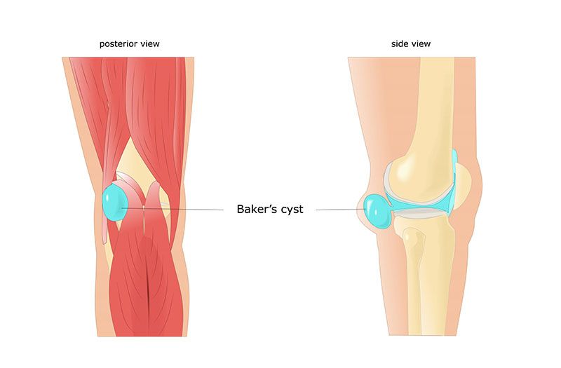 Tìm hiểu Kén Baker là gì và vai trò của nó trong cuộc sống hàng ngày