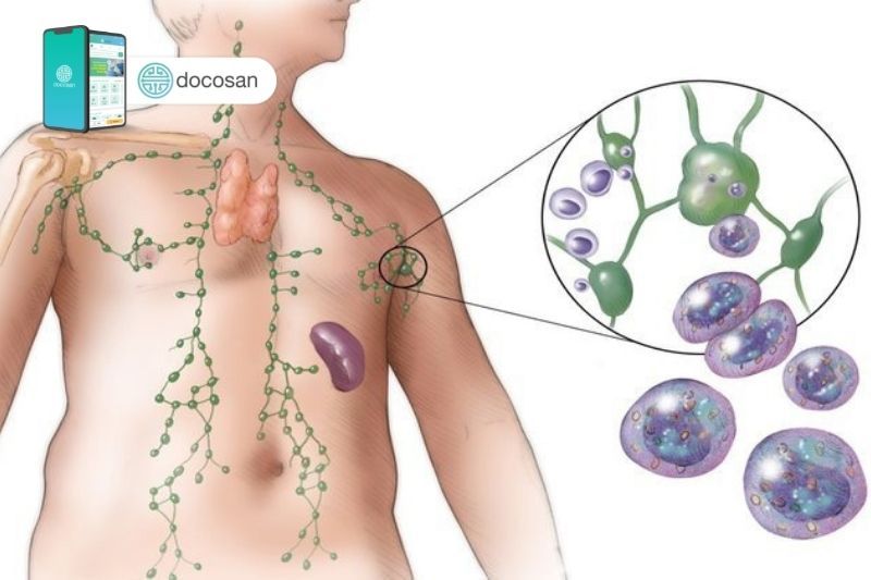 Tìm hiểu về lymphoma: Lymphoma là gì và các dấu hiệu cần chú ý