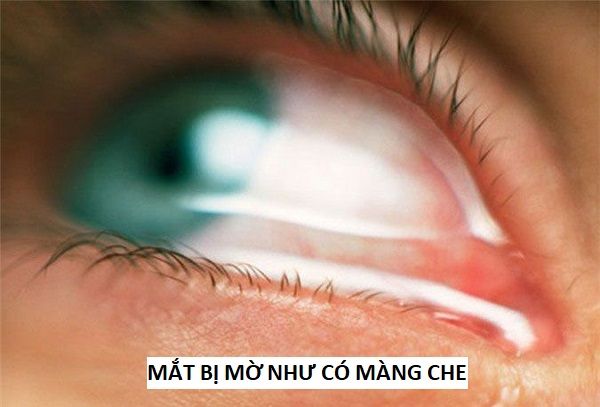 Mắt bị màng che - Tất cả những gì bạn cần biết