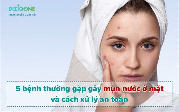 Mặt bị nổi mụn nước - Nguyên nhân, triệu chứng và cách chữa trị