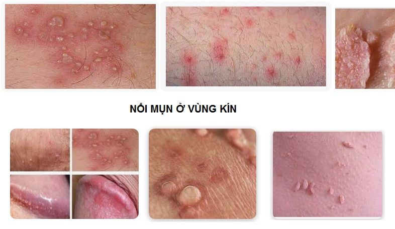 Mặt mọc mụn đỏ - Nguyên nhân, triệu chứng và cách trị hiệu quả