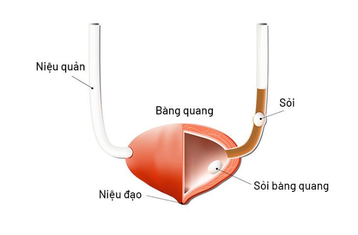 Mổ sỏi bàng quang - Tất cả những gì bạn cần biết