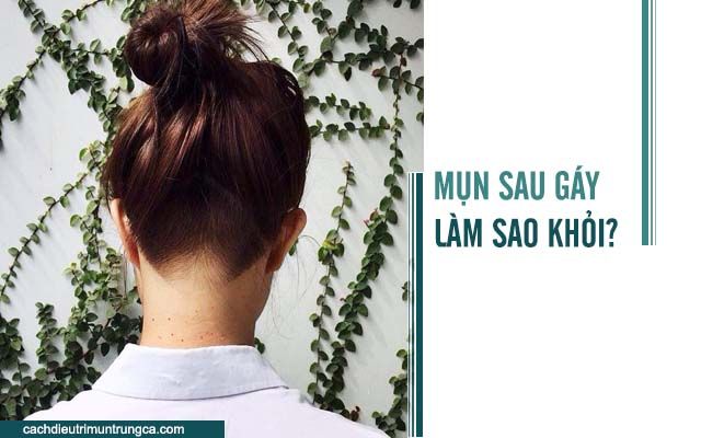 Mọc mụn đỏ ở sau gáy - Nguyên nhân và cách trị liệu hiệu quả