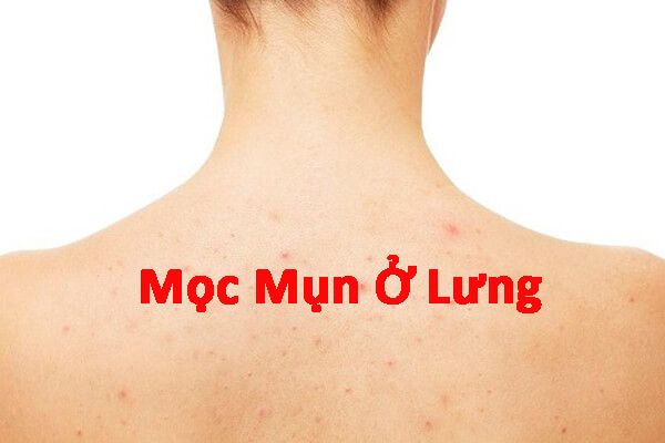 Mọc mụn ở lưng là bị bệnh gì? Tìm hiểu ngay để có giải pháp