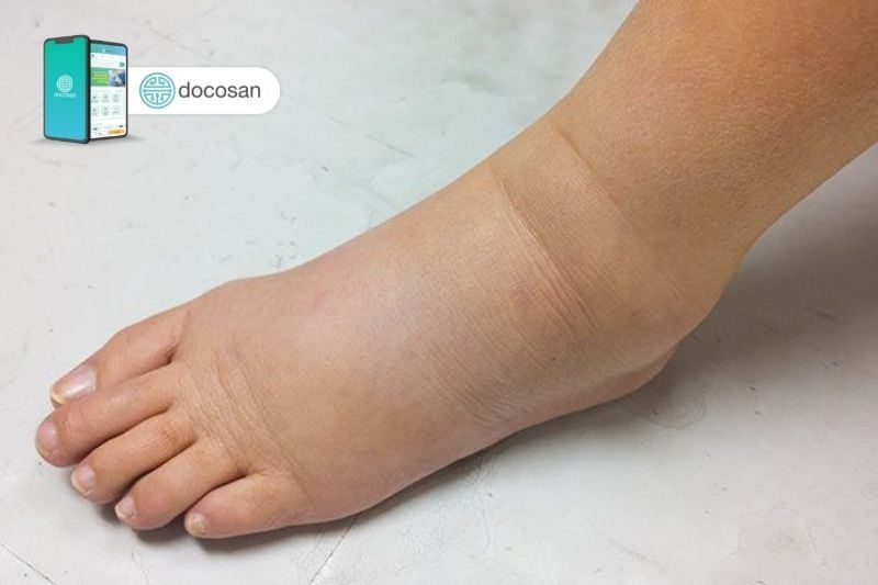 Tìm hiểu về mu bàn chân bị sưng phù: Nguyên nhân và cách điều trị