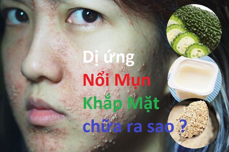 Mụn nổi khắp mặt phải làm sao? Tìm hiểu ngay cách giải quyết tình trạng này