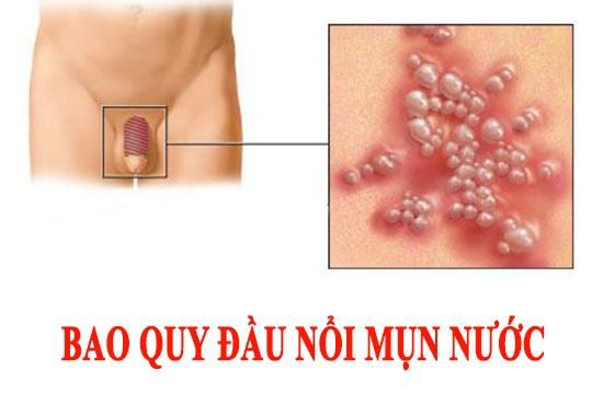 Mọi thứ bạn cần biết về mụn nước ở đầu