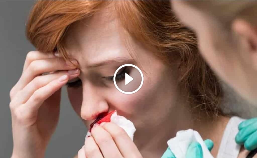 Nguyên nhân chảy máu cam ở người lớn - Tất cả những gì bạn cần biết