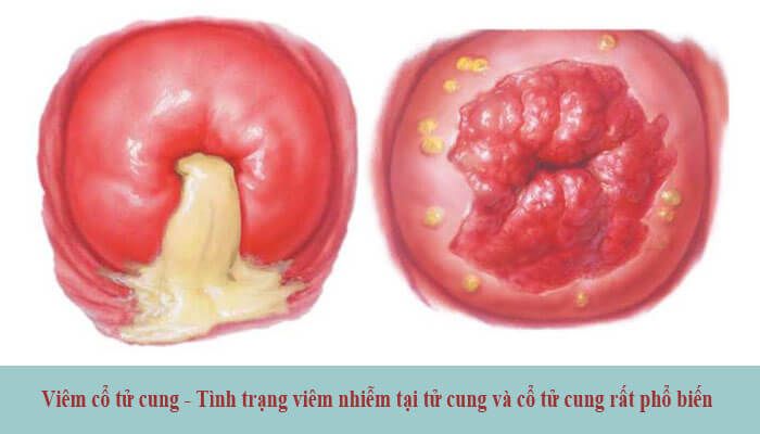 Những nguyên nhân gây viêm cổ tử cung là gì và cách phòng tránh