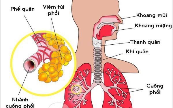 Nhiễm trùng hô hấp trên cấp: Triệu chứng, nguyên nhân và cách điều trị