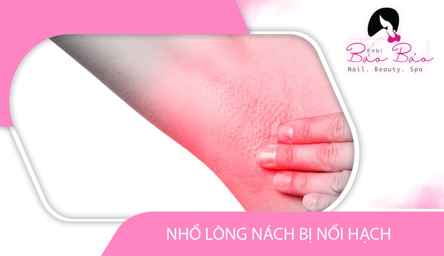 Nhổ lông nách bị nổi hạch - Nguyên nhân và cách xử lý