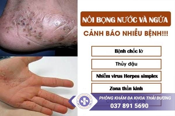 Tìm hiểu về nổi bọng nước nhỏ trên da và cách điều trị hiệu quả