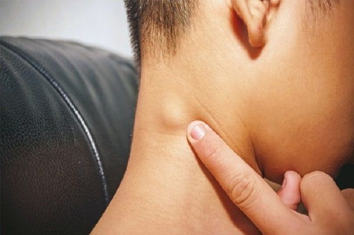 Nổi hạch ở sau gáy đau – Nguyên nhân, triệu chứng và cách điều trị