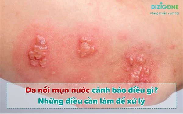 Nổi mụn nước khắp người: Nguyên nhân, triệu chứng và cách điều trị hiệu quả