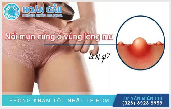 Nổi mụn ở mu: Nguyên nhân, triệu chứng và cách điều trị hiệu quả