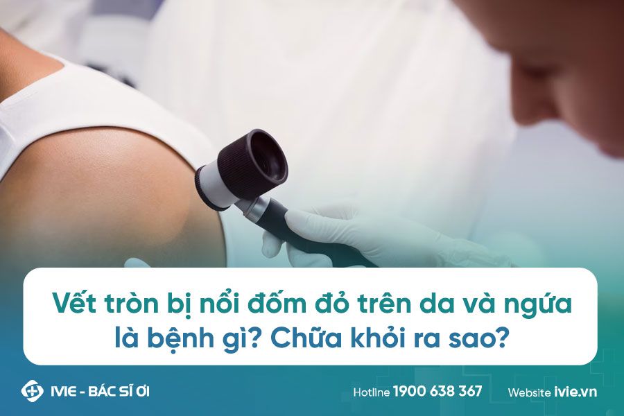 Nổi vết đỏ ngứa trên da: Nguyên nhân và cách điều trị